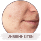 Microneedling gegen Unreinheiten