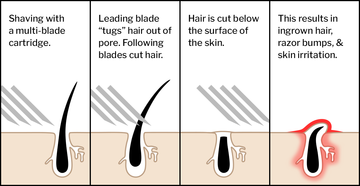 Multi-Blade Razor Causing Ingrown Hairs