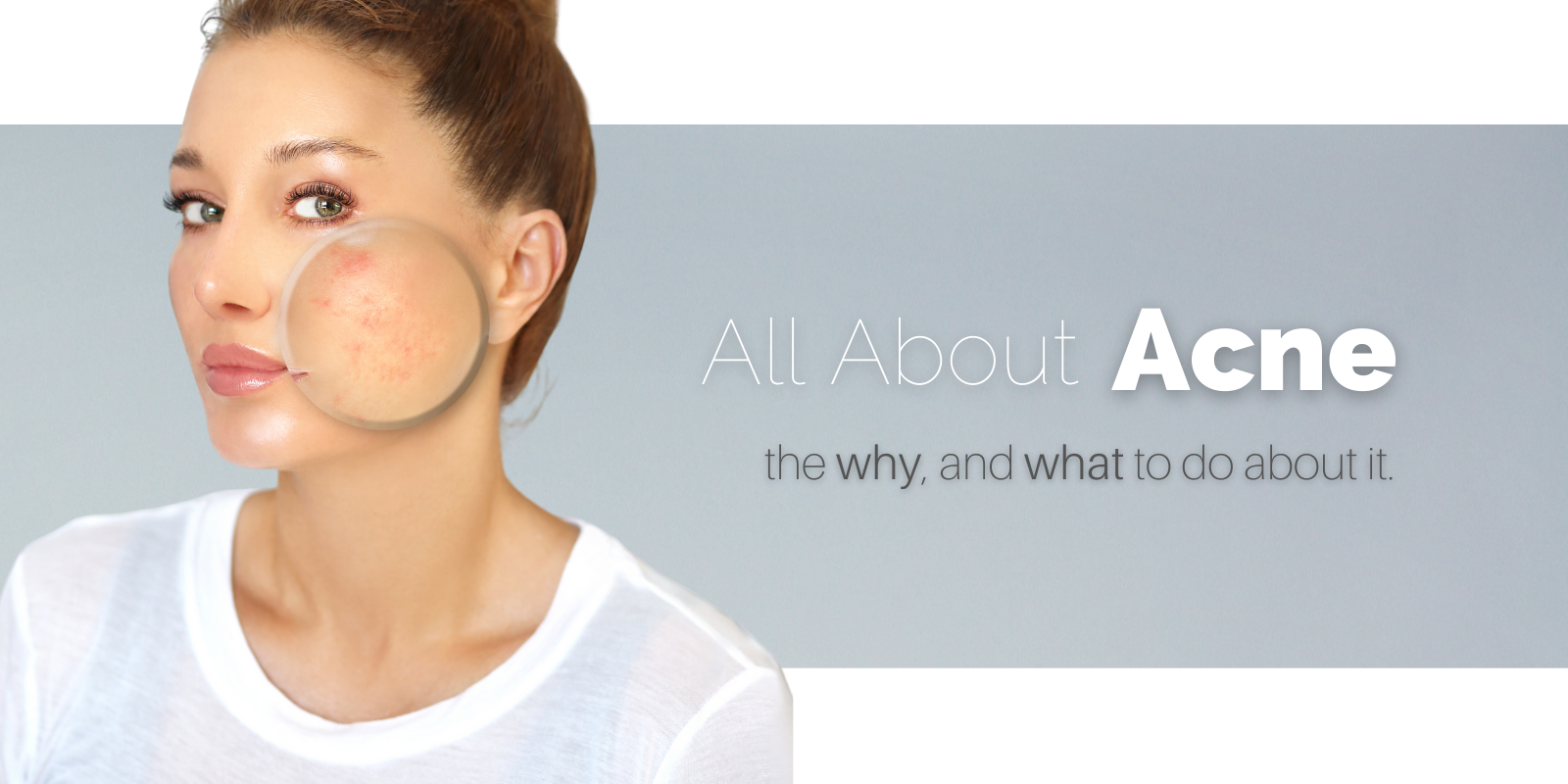 acne causes and acne treatments. Victoria BC