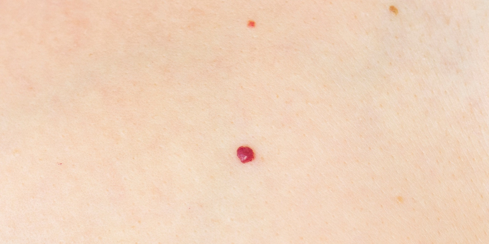 cherry angioma, red spots, capillaries. treatments in Victoria BC