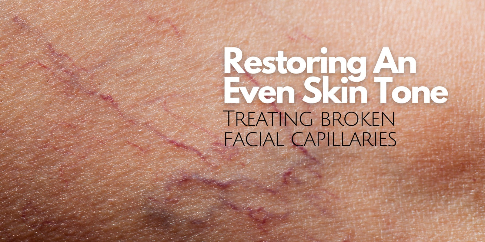 broken capillaries face treatment, treatment for broken capillaries, broken capillaries, Victoria BC