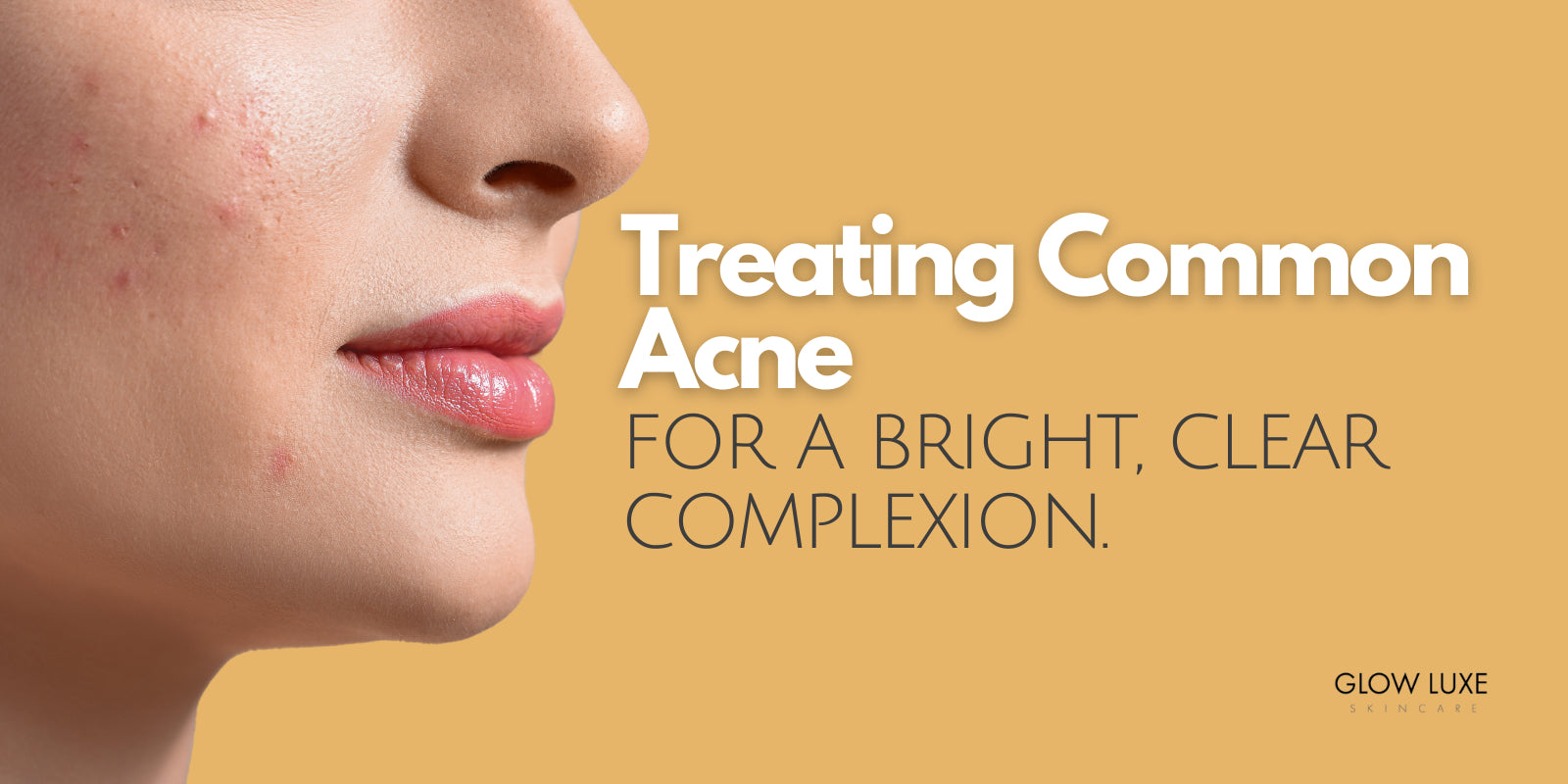 How to treat acne in Victoria BC. Acne treatment near me. Effective acne treatment.