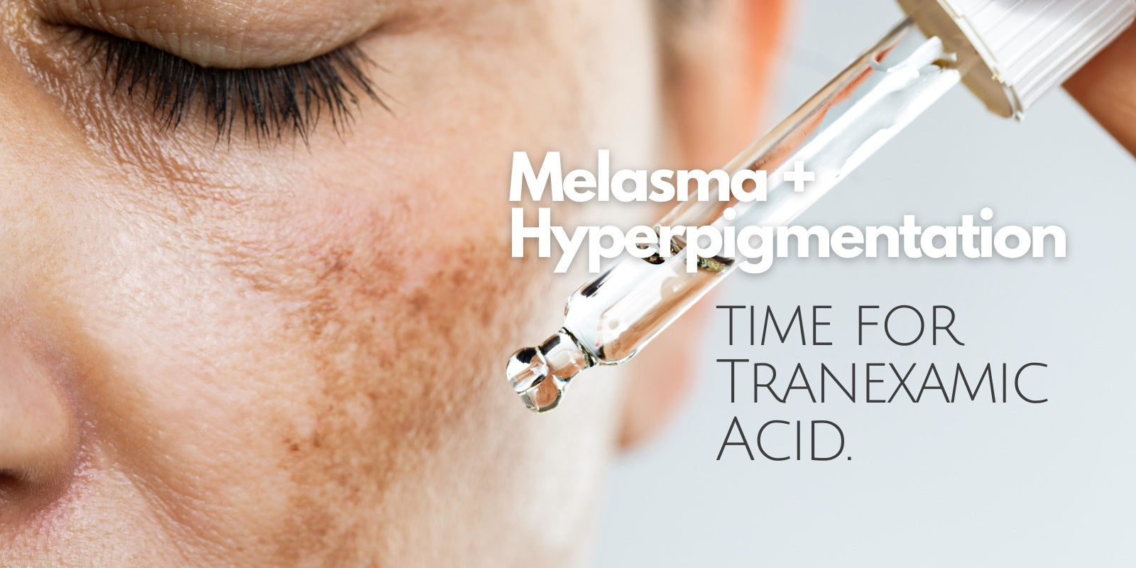 Tranexamic Acid, hyperpigmentation treatment, melasma treatment, skin discoloration