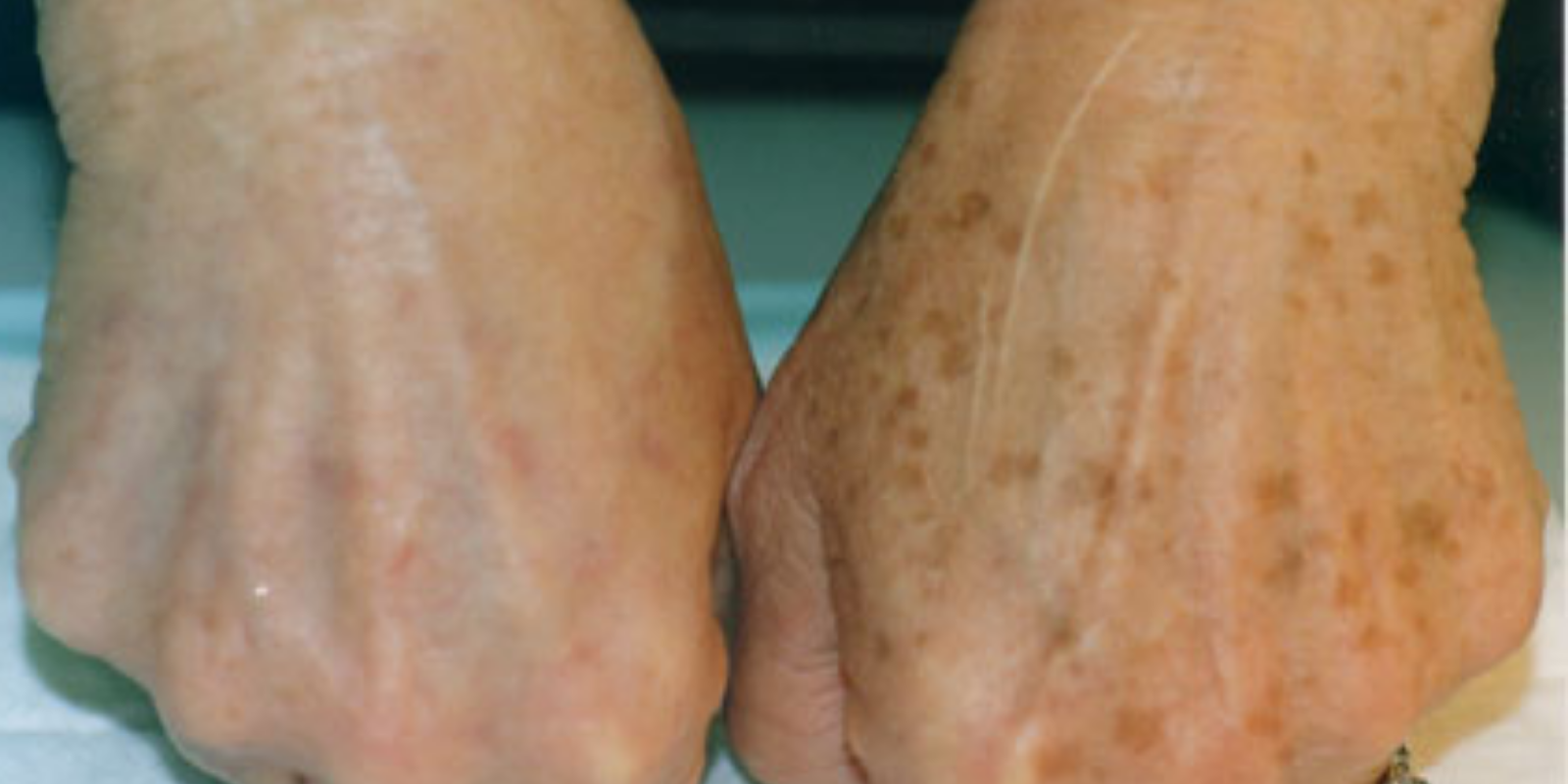 sun damage and age spots on hands. IPL Treatment Victoria BC