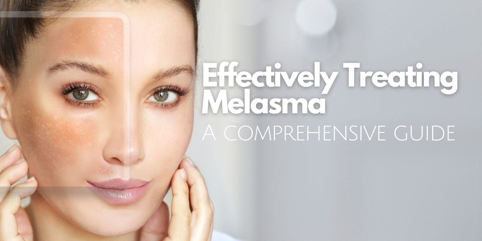 At Glow Luxe in Victoria BC, we see many clients with pigmentation concerns. While much of the pigmentation is due to sun damage and aging, some is due to a special pigmented condition called melasma.