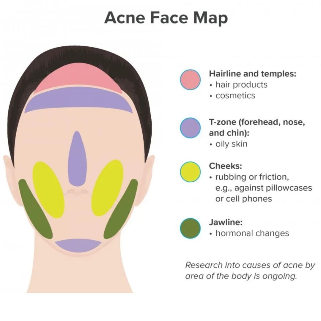 Acne Face Map