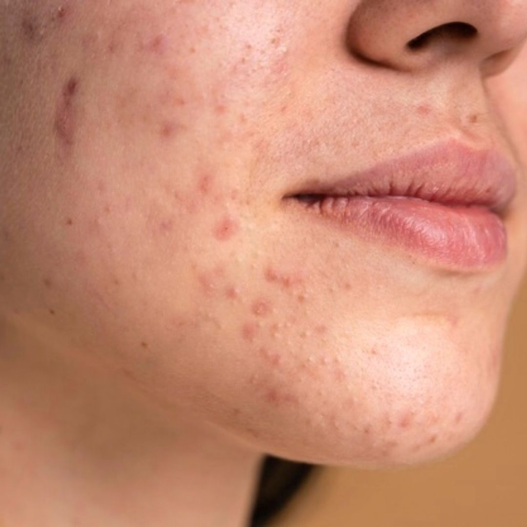 Women With Acne