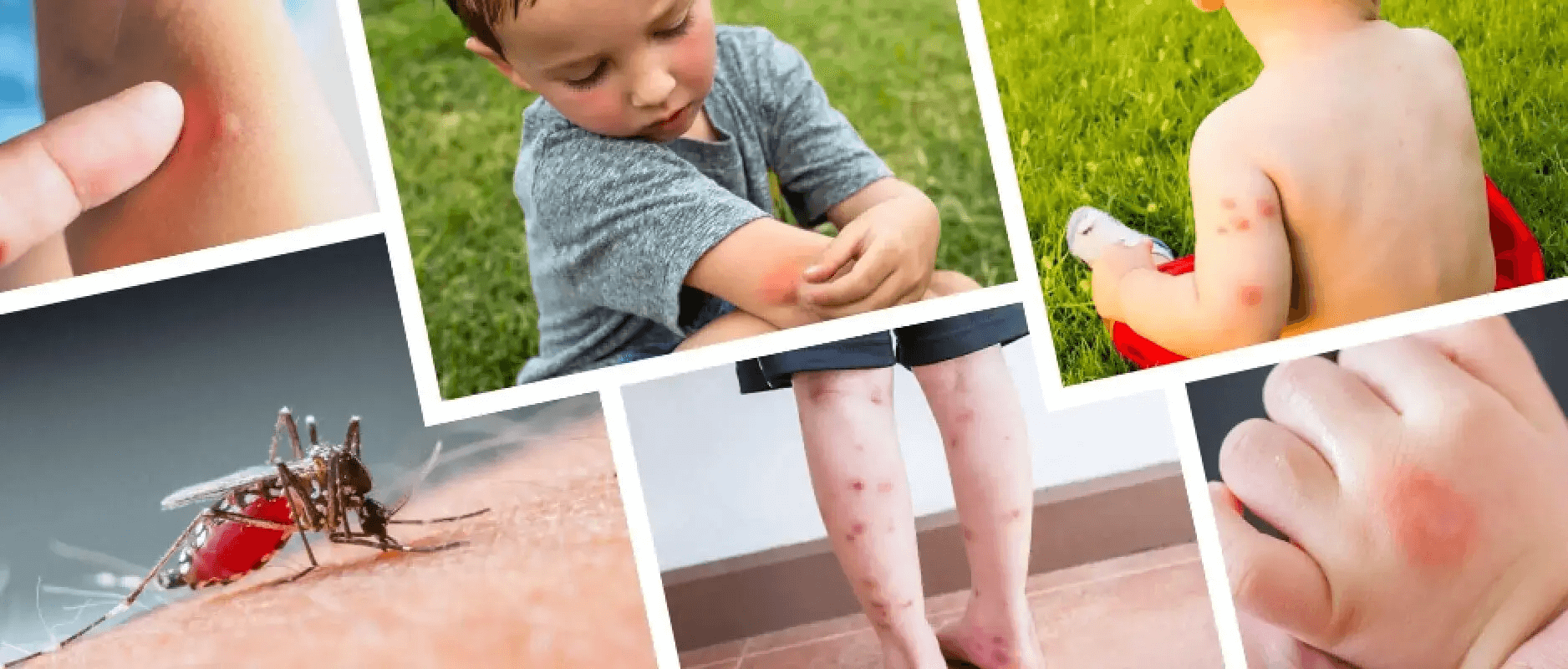 Collage of images showing mosquito bites on human skin.