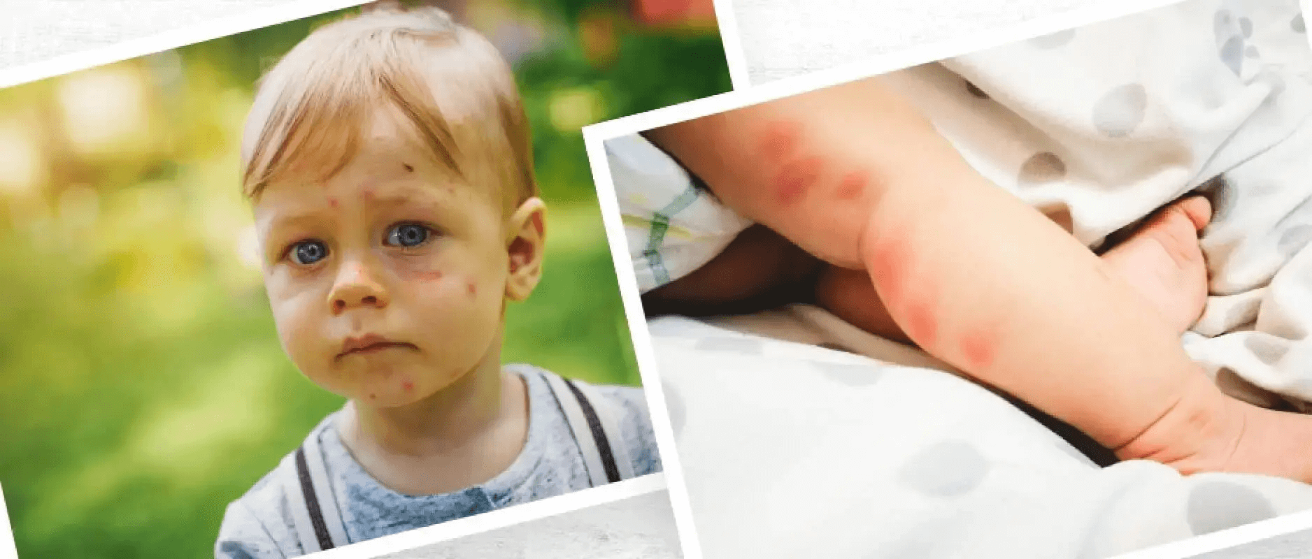 'Toddler with a bruised cheek and a zoomed-in view of a baby's leg with rash spots.'