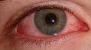 ocular rosacea symptoms