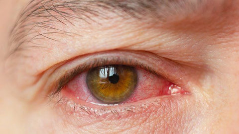 eye redness associated with dry eye syndrome