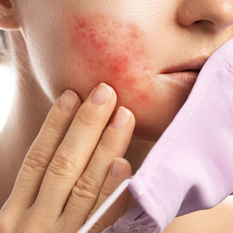 Causes and Triggers of Fungal Acne