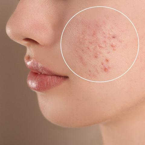 Other Factors That Influence Acne