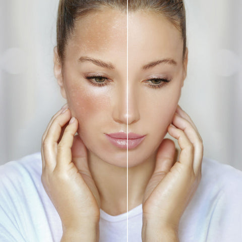 Skin Brightening and Hyperpigmentation Control