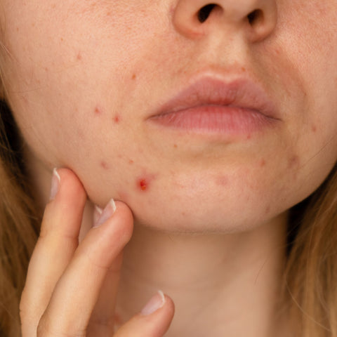 Understanding the Connection Between Dandruff and Facial Acne