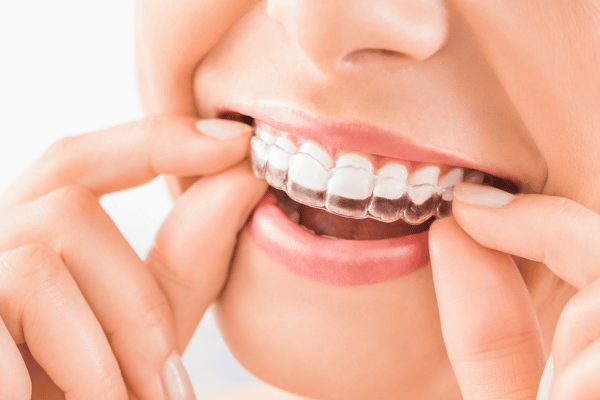 straighter teeth with clear aligners