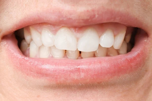teeth shifting