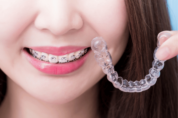 From Braces To Clear Aligners