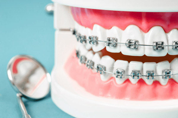  Traditional metal braces