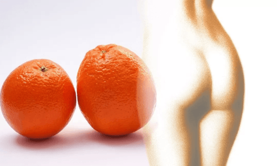 Cellulite come combatterla? - Agocap Pharma & Beauty