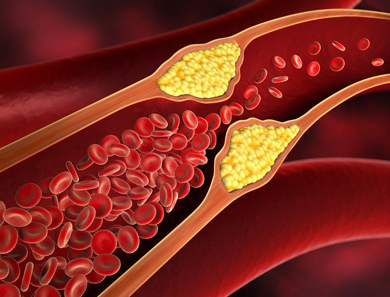 Arterienverkalkung