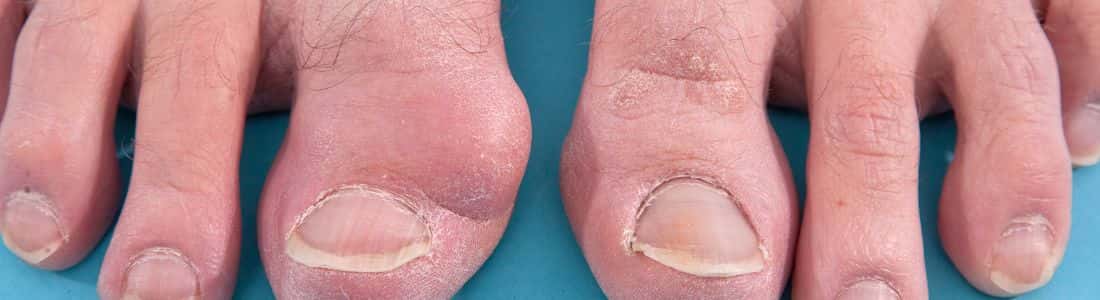 There are lots of different causes of bunions