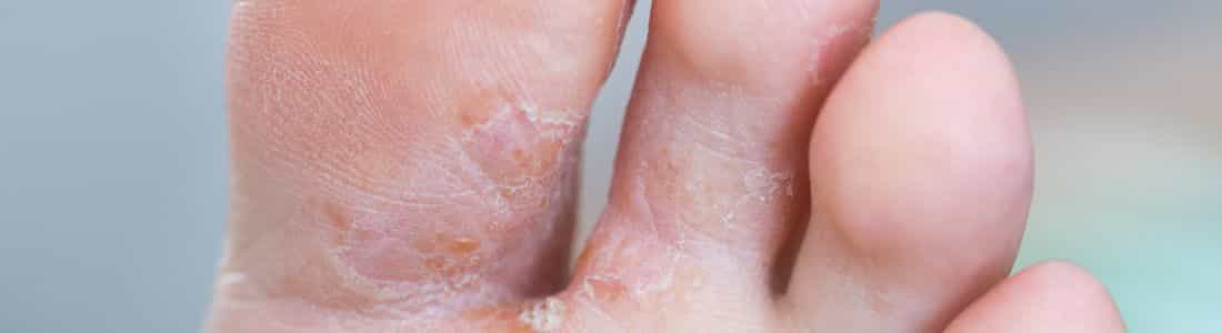 Athlete's Foot can cause foot pain when running