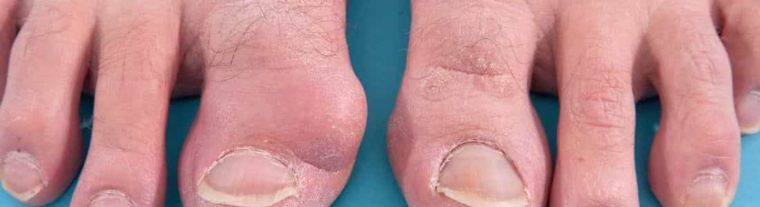 Bunions can cause foot pain when running