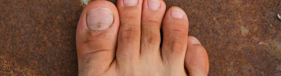 Morton's Neuroma can cause pressure pain in the toes