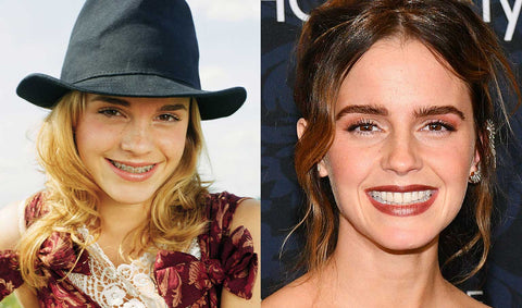 Emma Watson braces