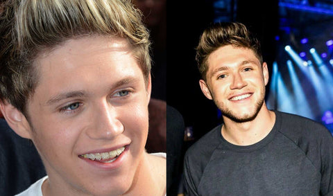 Niall Horan with braces