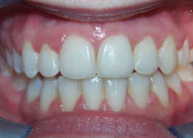 Ceramic Brace Case Studies 2 | Manchester Orthodontics