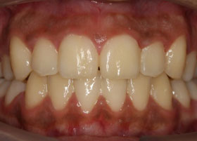 Ceramic Braces Case Studies 5 | Manchester Orthodontics