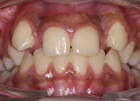 Ceramic Braces Case Study 3 | Manchester Orthodontics