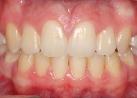 Ceramic Braces Case Study 7 | Manchester Orthodontics