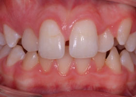 Ceramic Braces Case Study 6 | Manchester Orthodontics