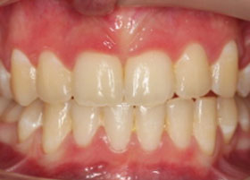 Ceramic Braces Case Study 11 | Manchester Orthodontics 