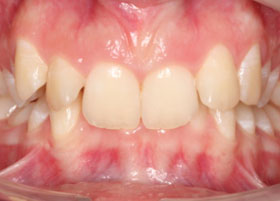 Ceramic Braces Case Study 11 | Manchester Orthodontics