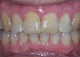 Ceramic Braces Case Study 14 | Manchester Orthodontics