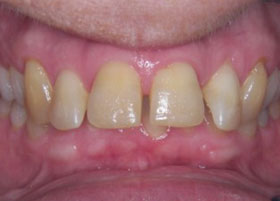 Ceramic Braces Case Study 13 | Manchester Orthodontics