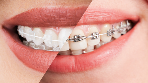 Metal Braces or Ceramic Braces