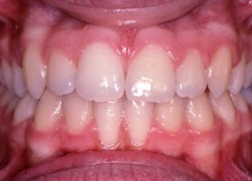 Invisalign Braces | Manchester Orthodontics