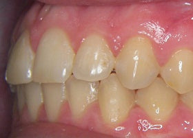 Invisalign Case Study 9 | Manchester Orthodontics