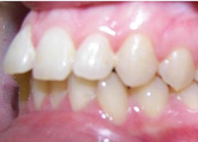 Invisalign Braces | Manchesters No.1 Orthodontics