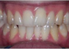 Invisalign Braces | Manchester Orthodontics