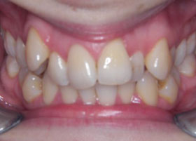 Lingual Brace Case Studies | Manchester Orthodontics