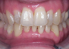Lingual brace case studies | Manchester Orthodontics