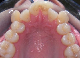 Lingual brace case studies | Manchester Orthodontics 