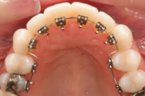 Brace Care Top Tips | Northenden Orthodontics