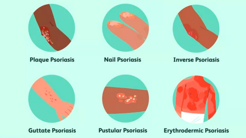 types of psoriasis